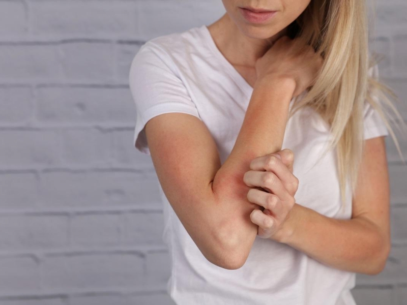 Cause, Sintomi e Rimedi per la Dermatite Atopica