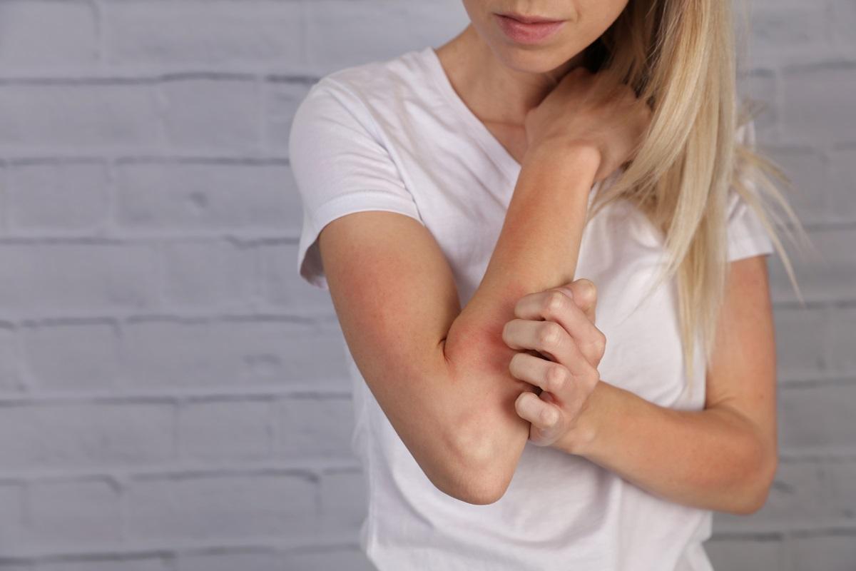 Cause, Sintomi e Rimedi per la Dermatite Atopica