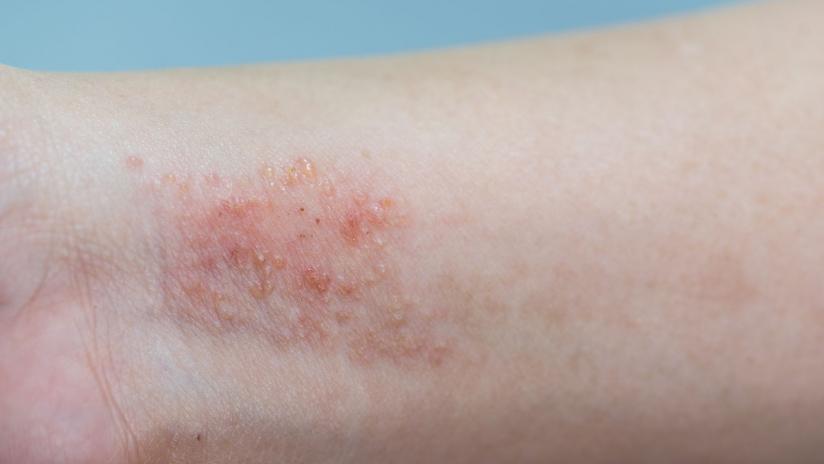 irritazione e rossore della pelle dovuta ad un eczema
