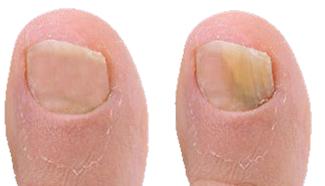 Unghia dei piedi affette da onicomicosi